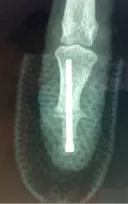 arthrose