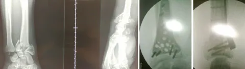 fracturepoignet