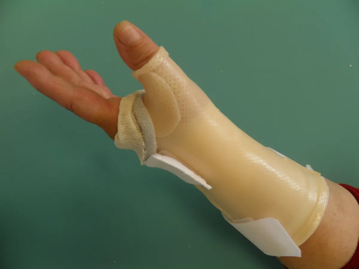 rhizarthrose_chirurgie_longue rhizarthrose_chirurgie_longue